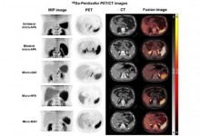 新的 PET/CT 技术可准确诊断肾上腺疾病